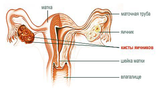 Кисты яичника