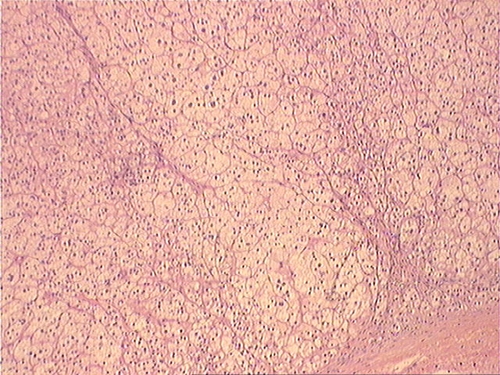 Кортикостерома