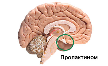 Пролактинома гипофиза