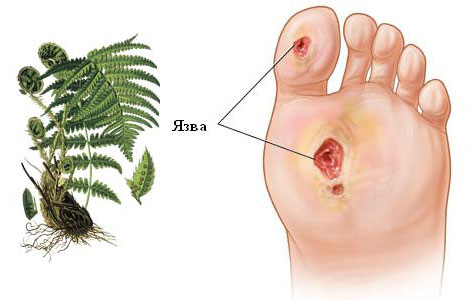 Трофическая язва