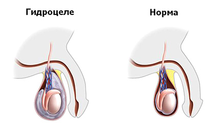 Водянка оболочек яичек у мужчин